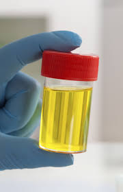 Urine Sample Karachi Home Health care Services (www.UNIQUE-hms.com)